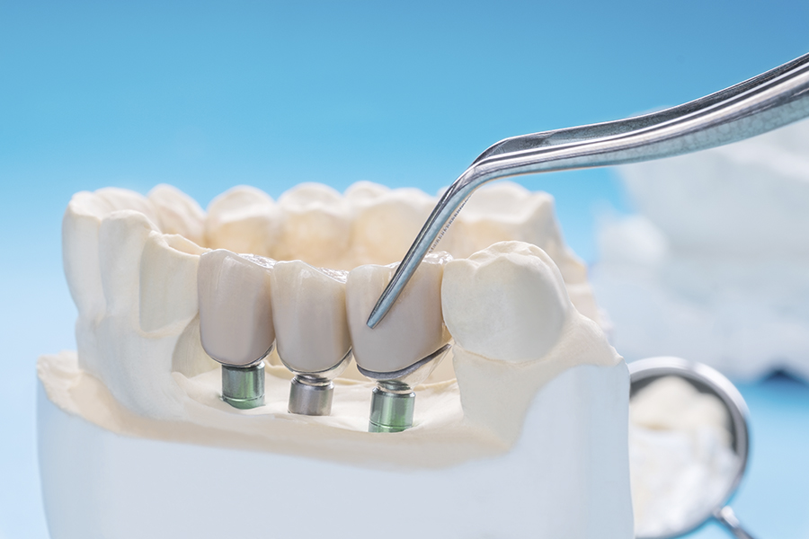 implantes dentales lasersmile